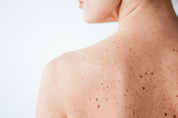 MelanomaMonday_Dermat.png